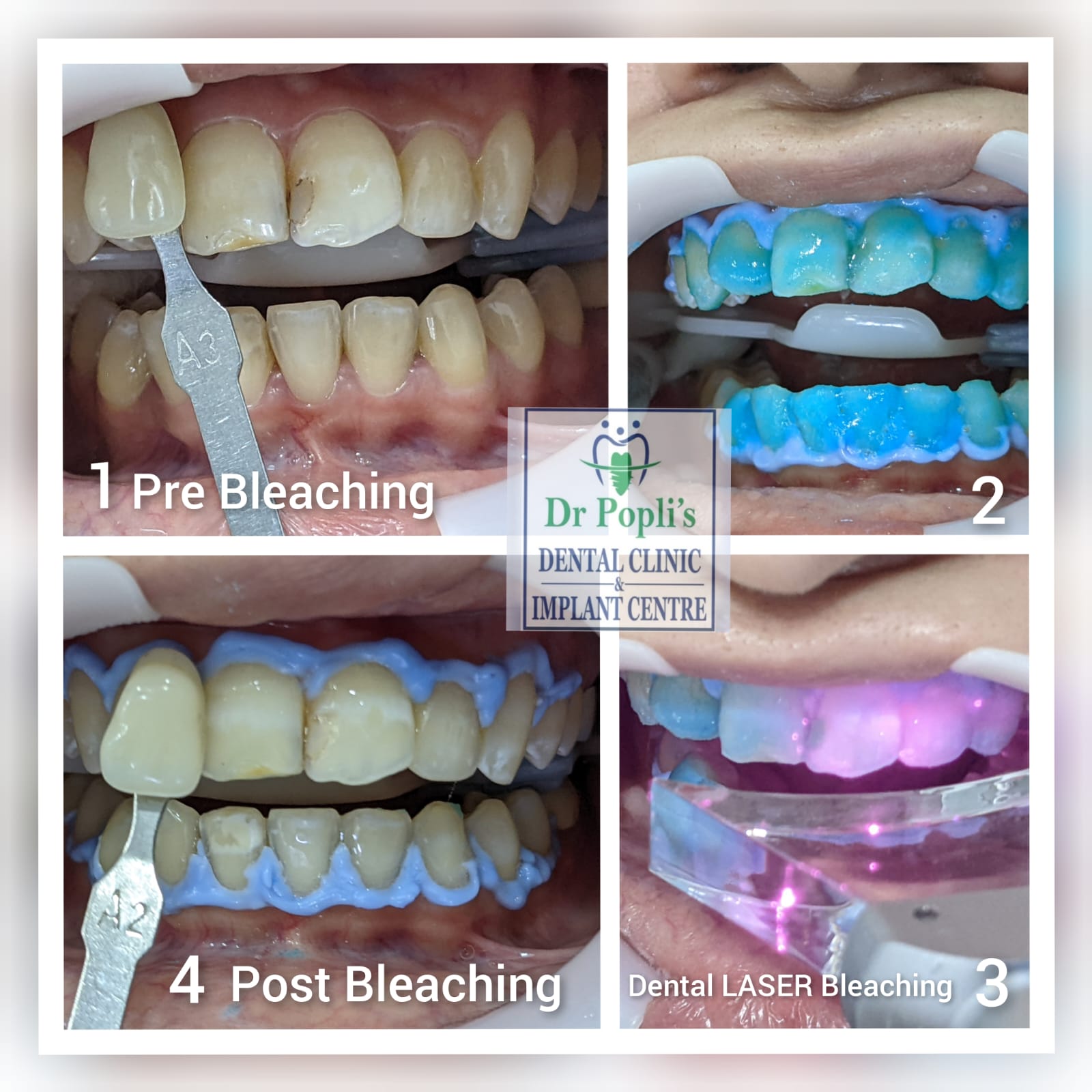 Pre Bleaching
