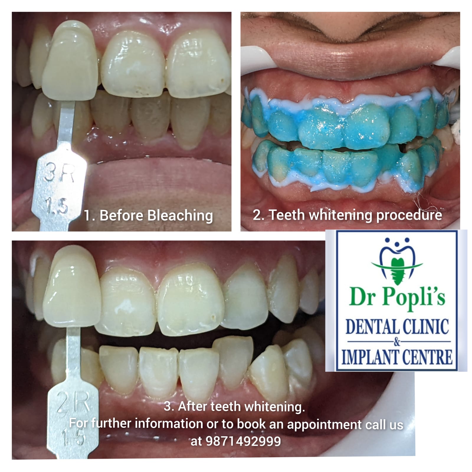 Teeth Whitening