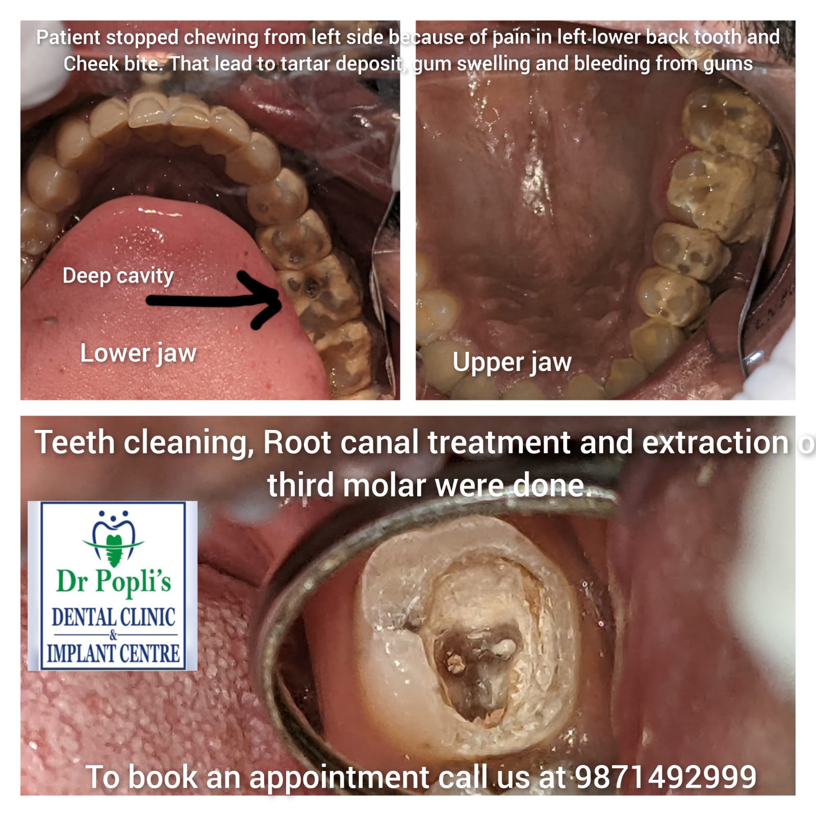 Teeth Cleaning