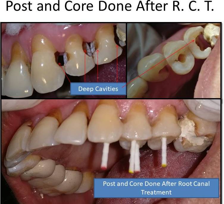 Hollow teeth restored