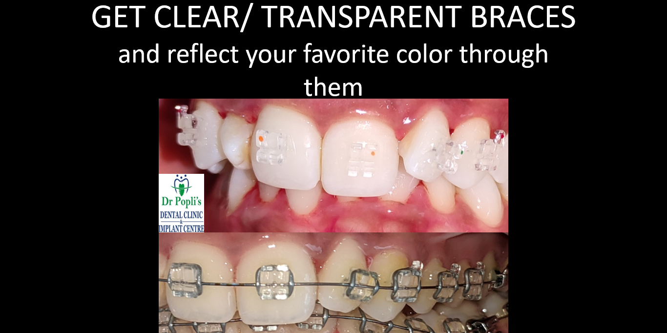 Transparent braces