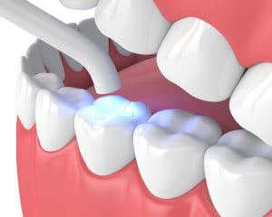 Cosmetic Dental Filling in Delhi