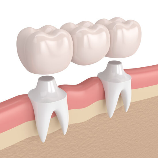 Metal Free Crowns And Bridges in Delhi